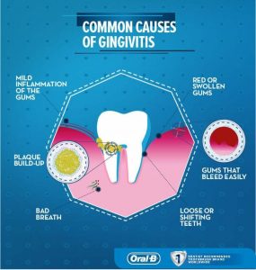 common-causes-of-gingivitis